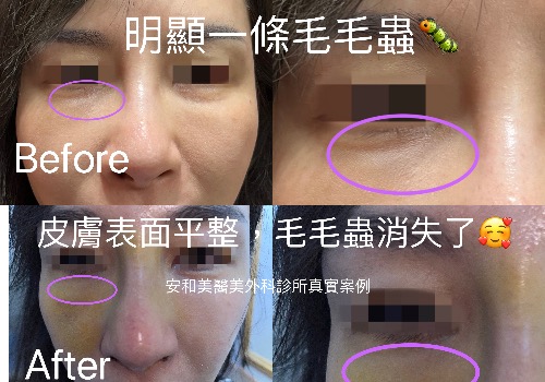淚溝毛毛蟲重修手術