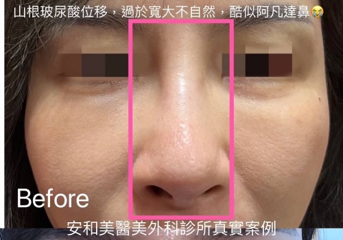 阿凡達鼻重修手術
