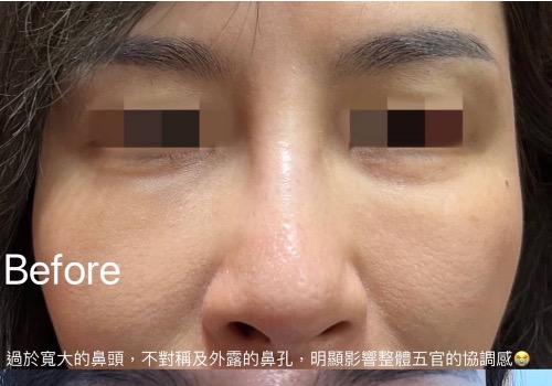 埋線隆鼻鼻孔不對稱縮鼻翼重修手術