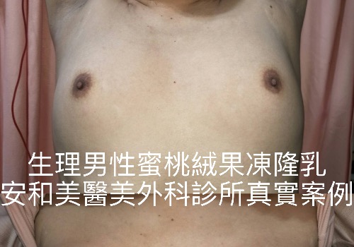 生理男性蜜桃絨果凍隆乳